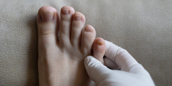 Fungal nail