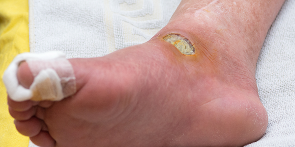 Diabetic Foot