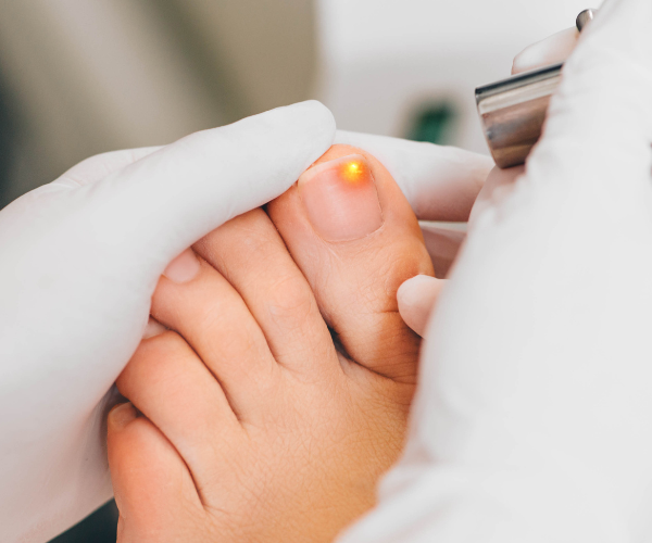 Fungal Toenails (1)