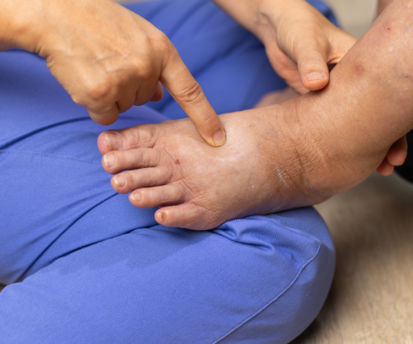 Lymphedema