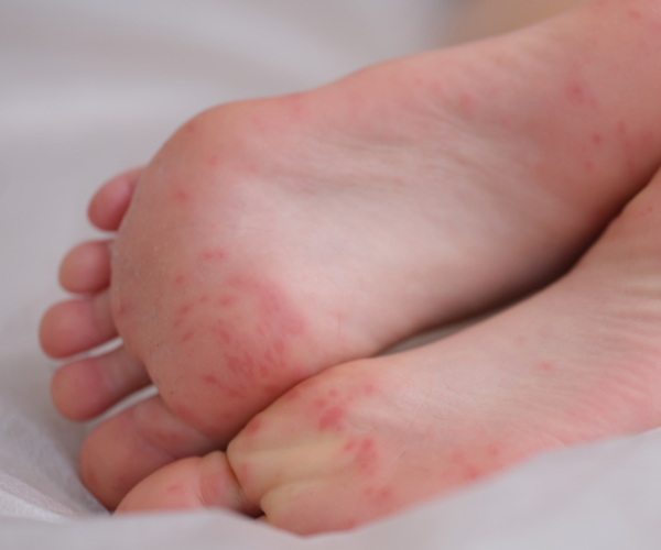Rashes and Dry Skin