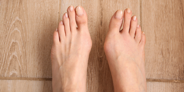 Bunions-600x300